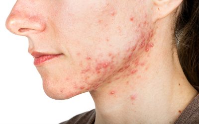 Cura l’acne con la terapia biofotonica!