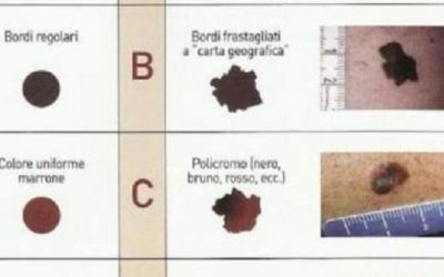 Chirurgia Micrografica di MOHS per i tumori cutanei